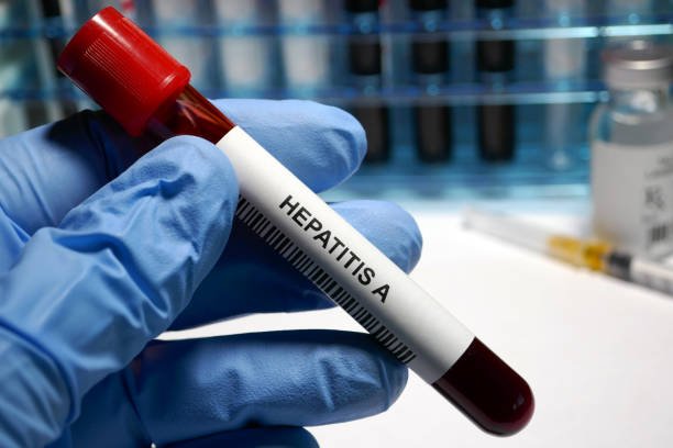 A tomar precauciones el Ministerio de Salud reporta brote por casos de hepatitis A