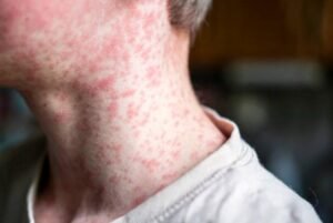 Alerta por sarampión: Costa Rica registra cinco casos mientras aumentan contagios en América